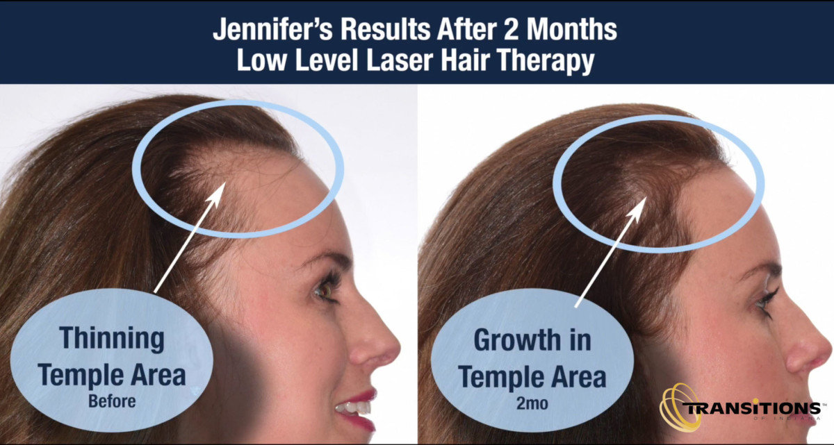PRP Hair Loss Treatment - Transitions of Indiana