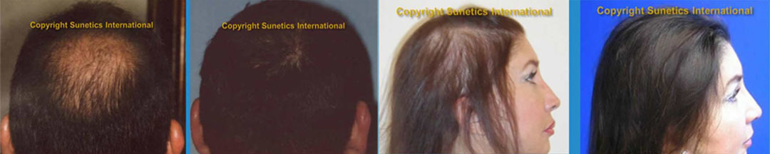 FDA Approved Laser Hair Therapy - Transitions of Indiana