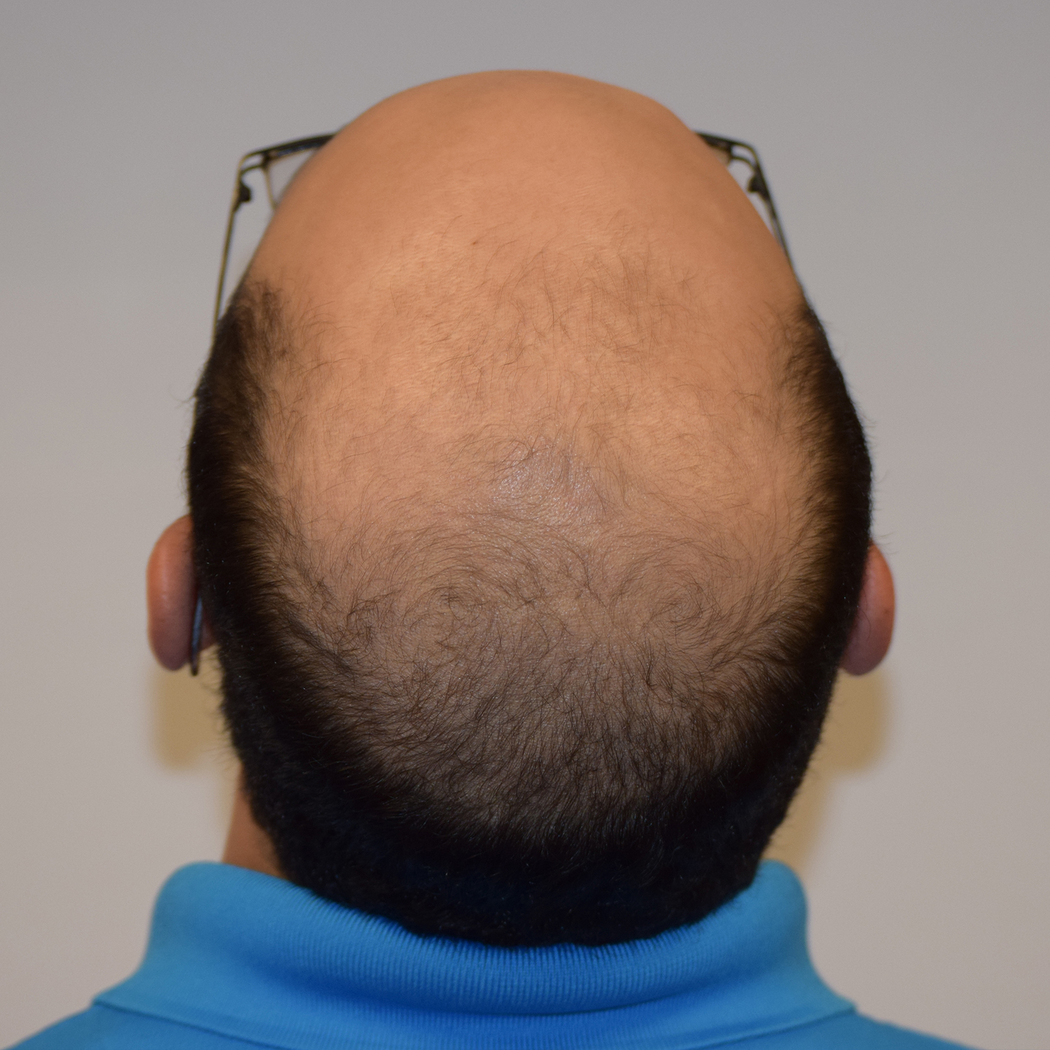 Bryan-BackTilt-Before