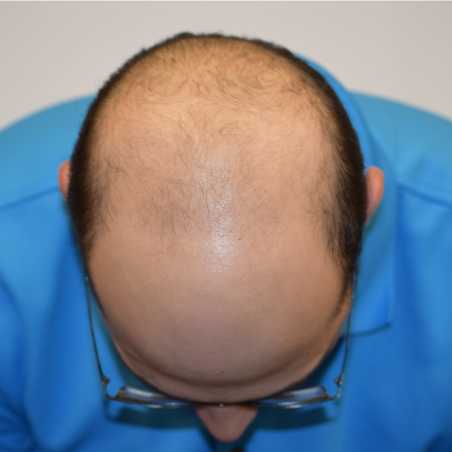 Bryan-FrontTilt-Before