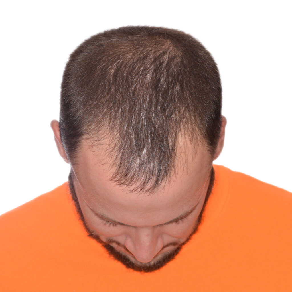 Nick-Angeloff-FrontTilt-Before2