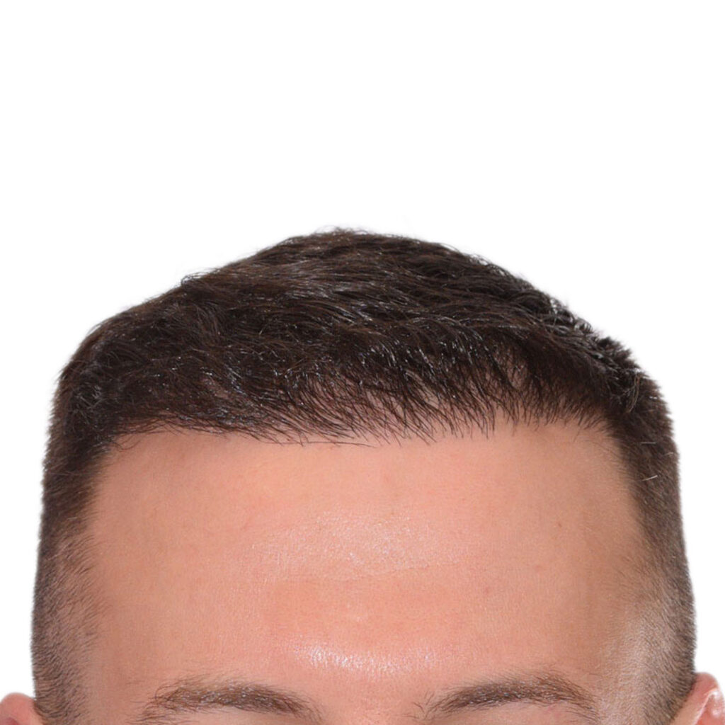 Nick-Angeloff-Hairline-After2