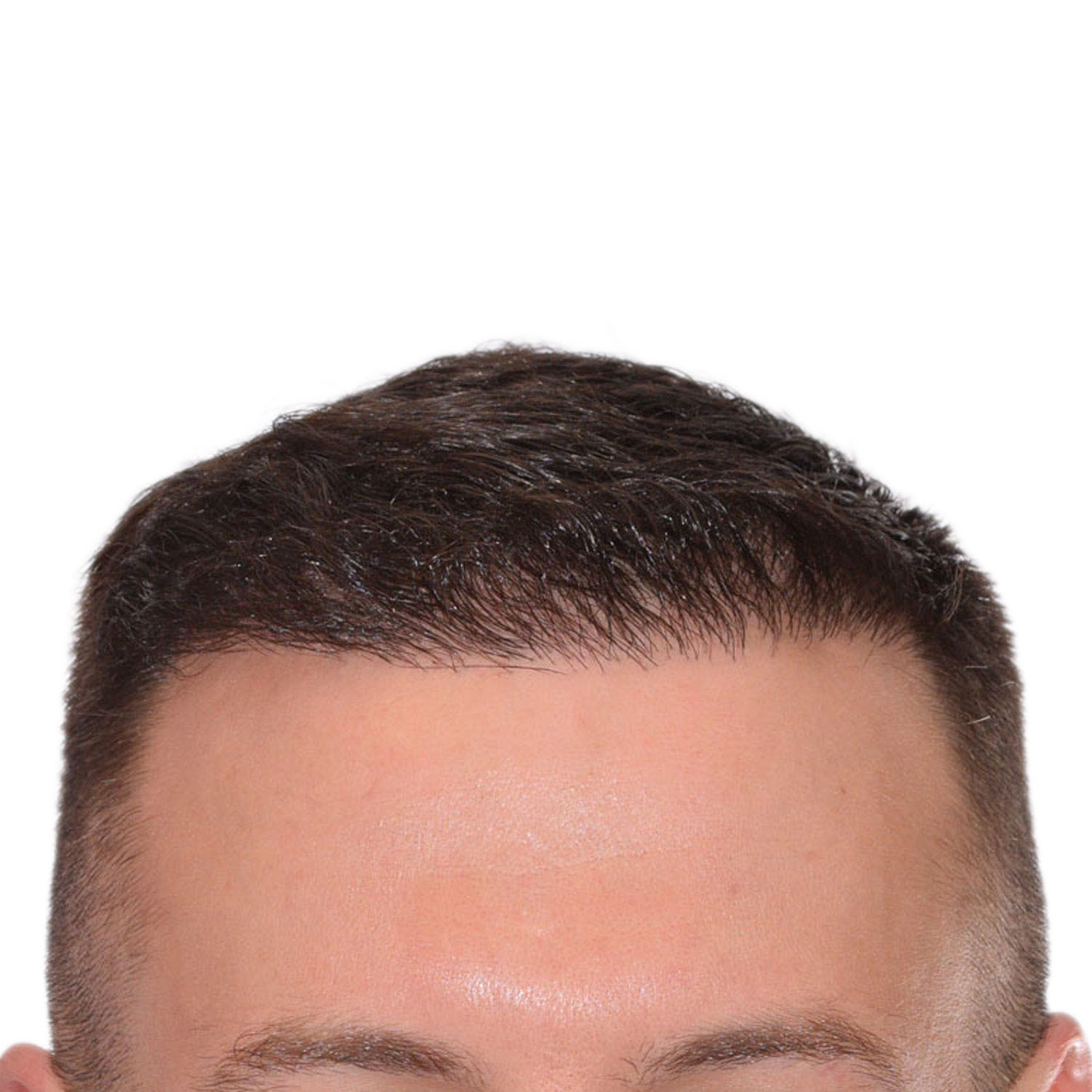 Nick-Angeloff-Hairline-After2