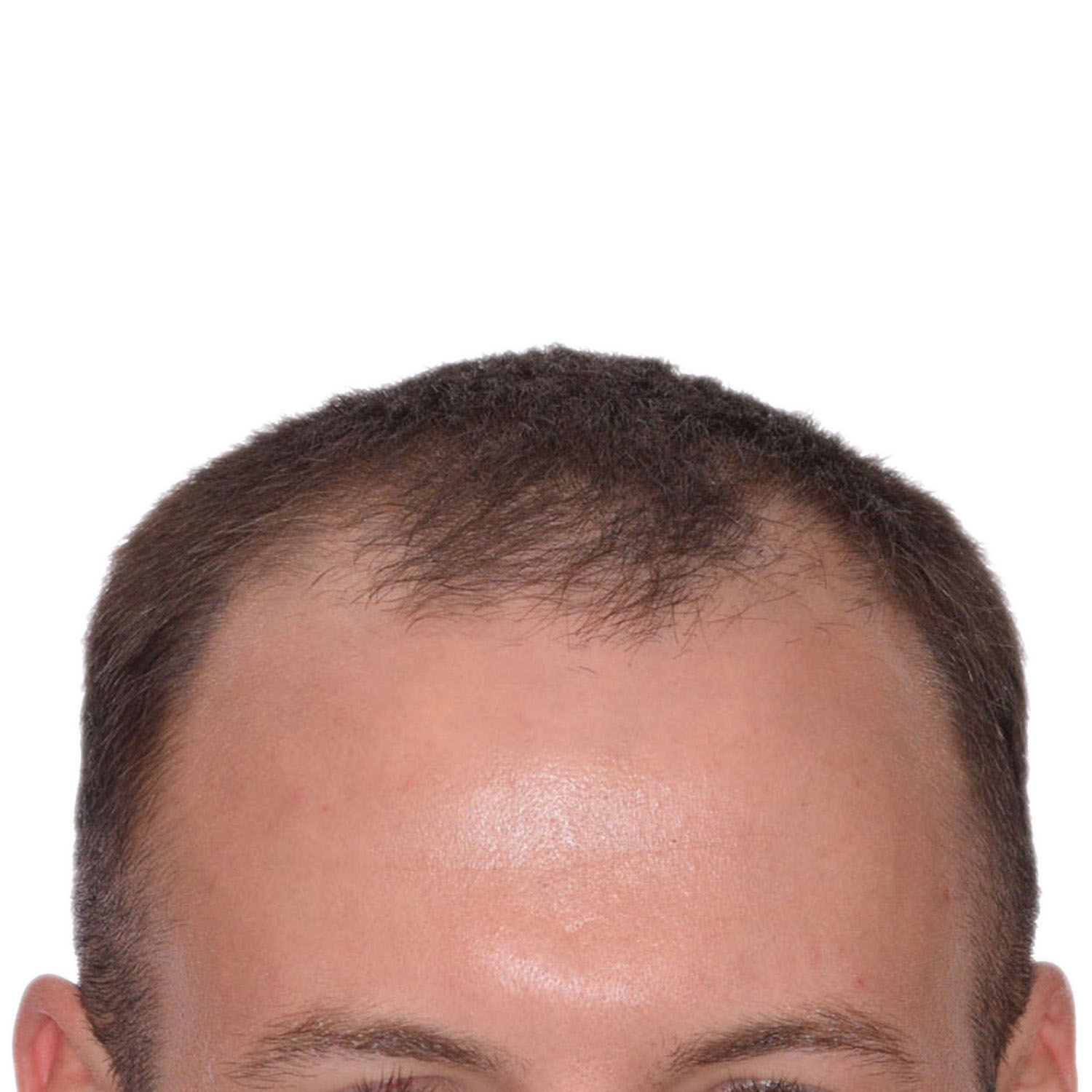 Nick-Angeloff-Hairline-Before2