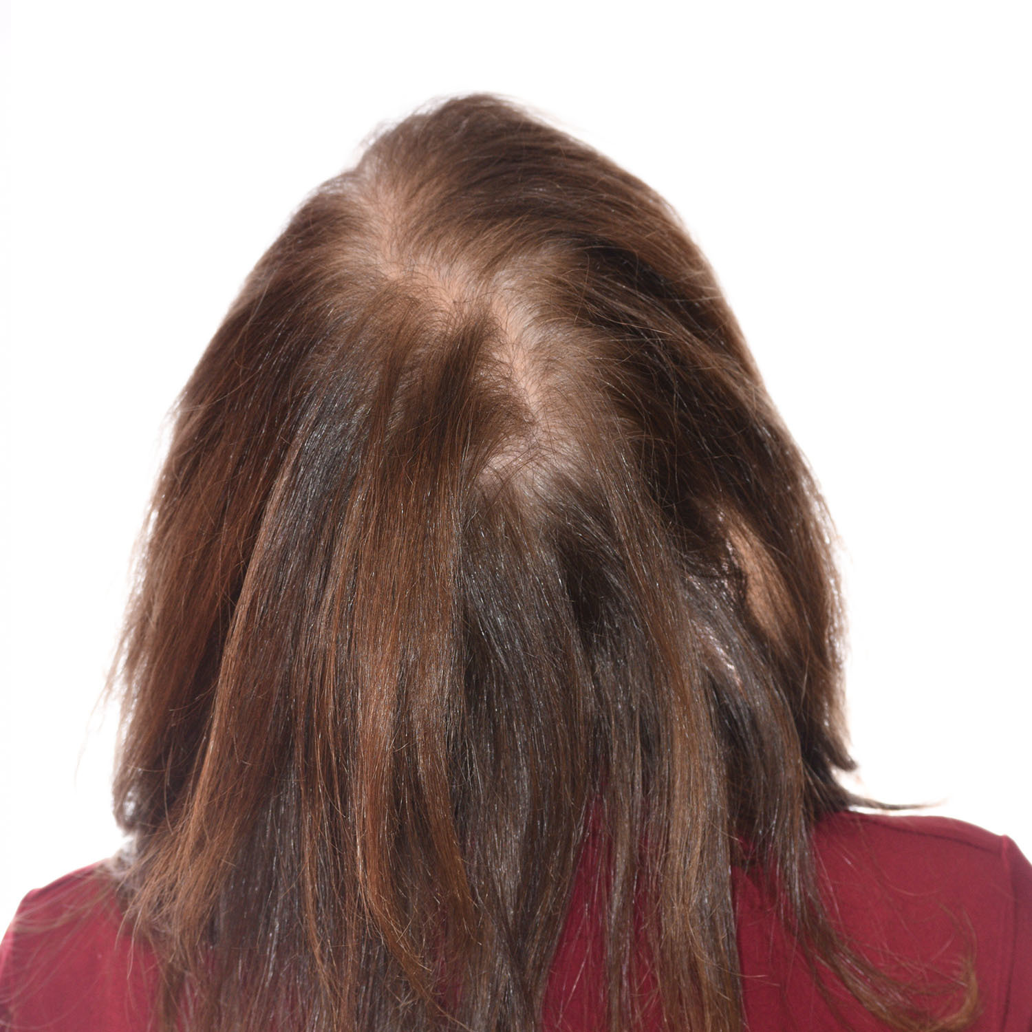 Ann-Richards-BackTilt-Before