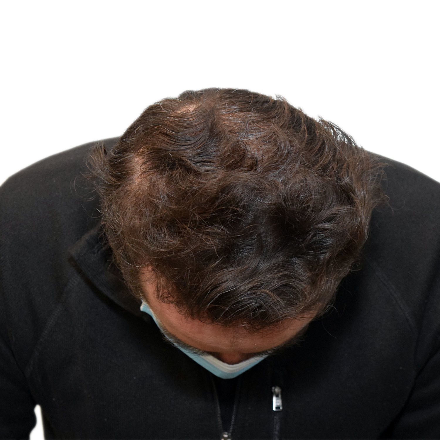 Javier-Aguilar-Front-Tilt-After-8-Weeks