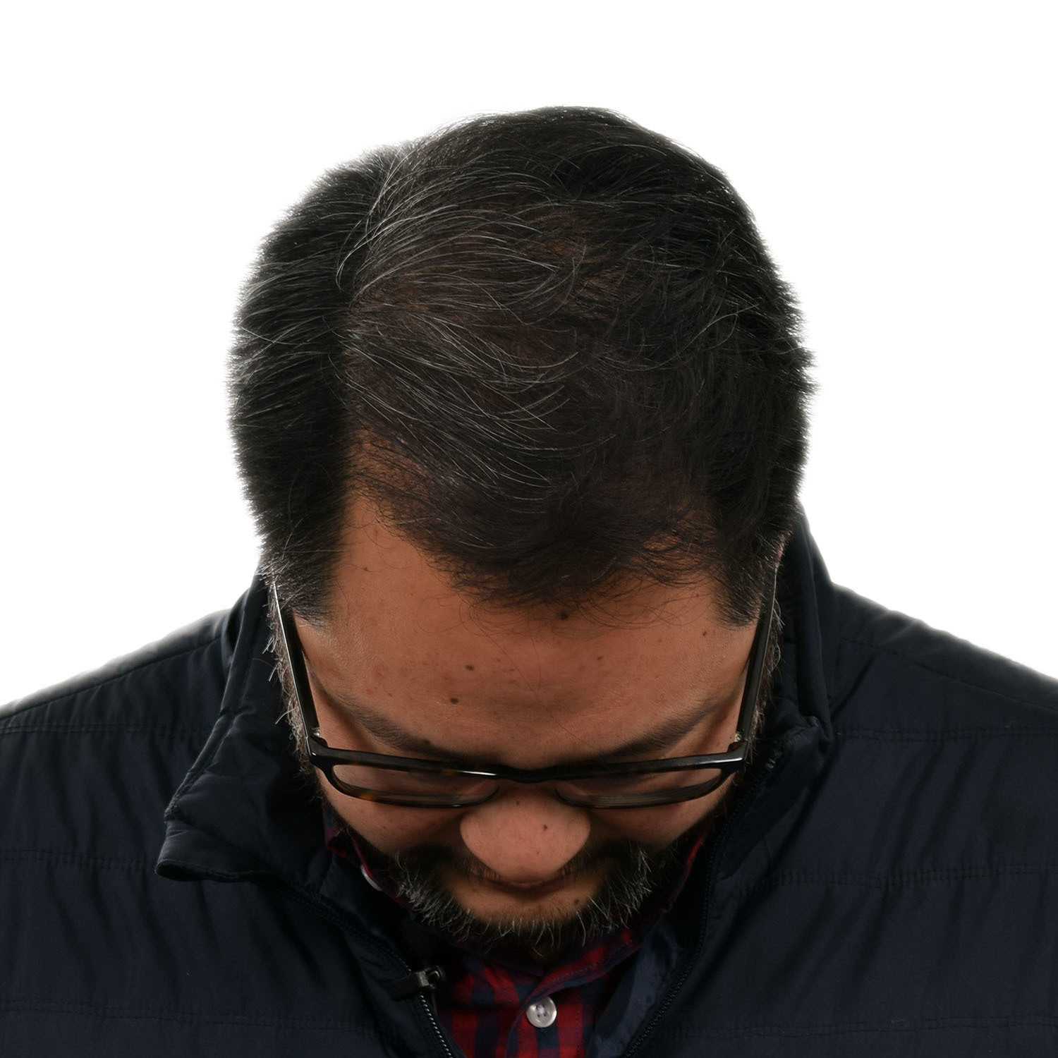 Justin-Lo-Front-Tilt-After