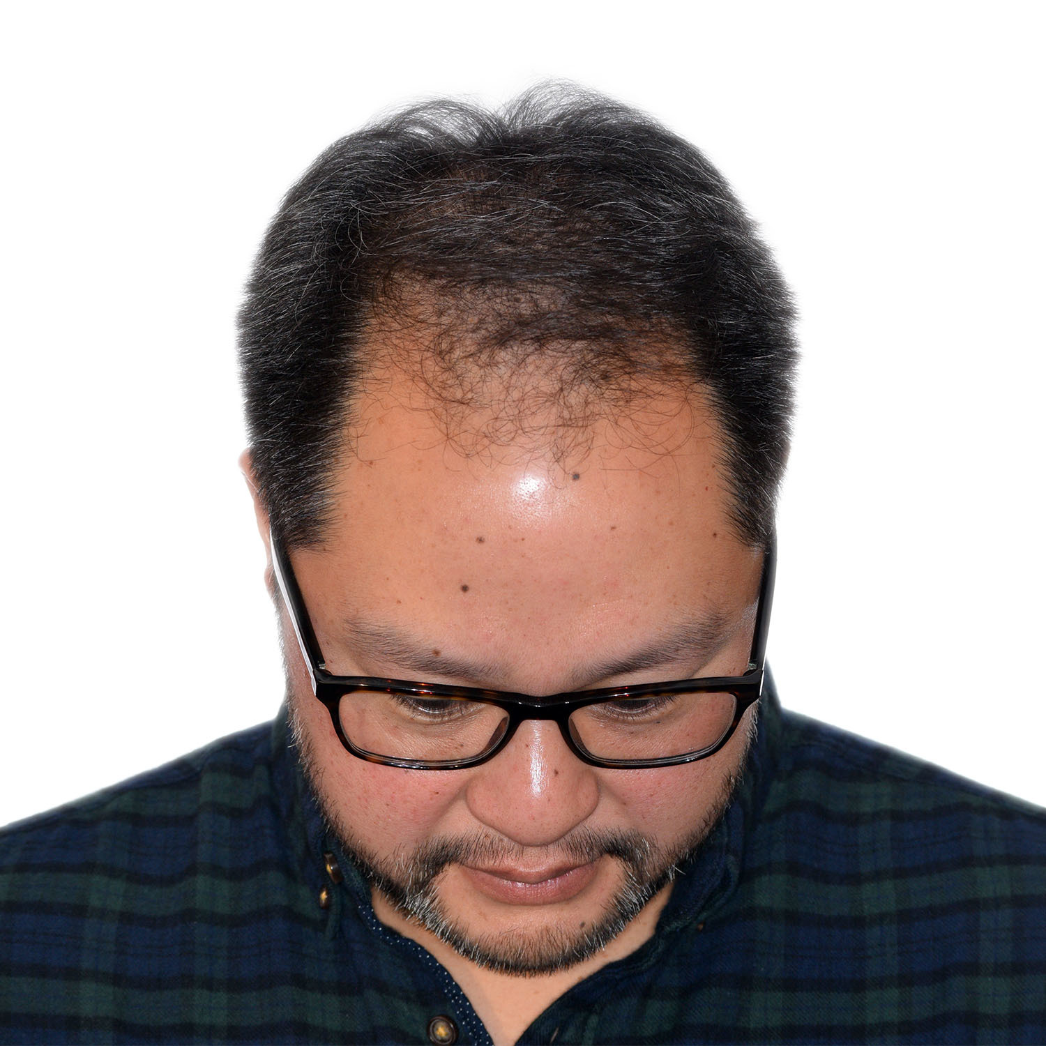 Justin-Lo-Front-Tilt-Before