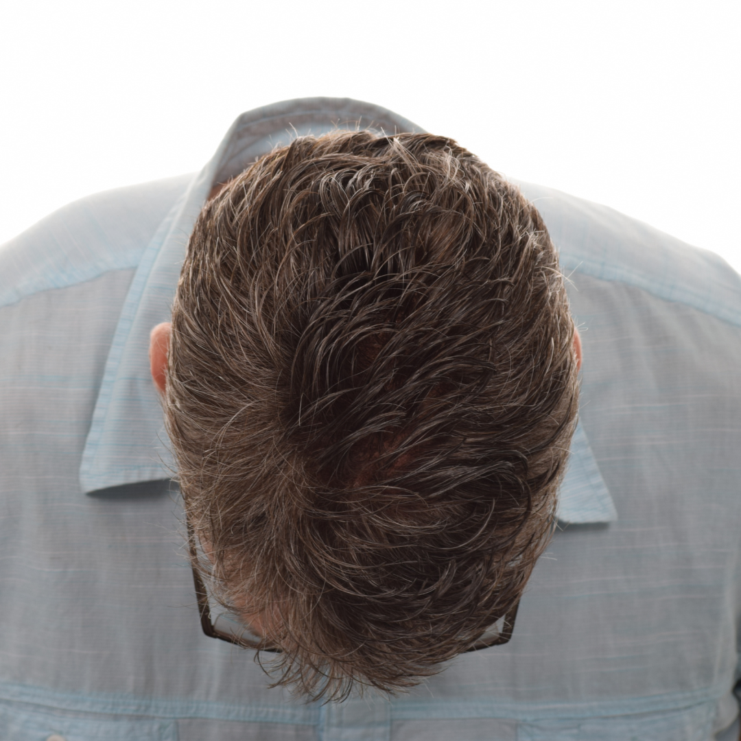 Jason-Shawver-Non-Surg-After-Front-Tilt