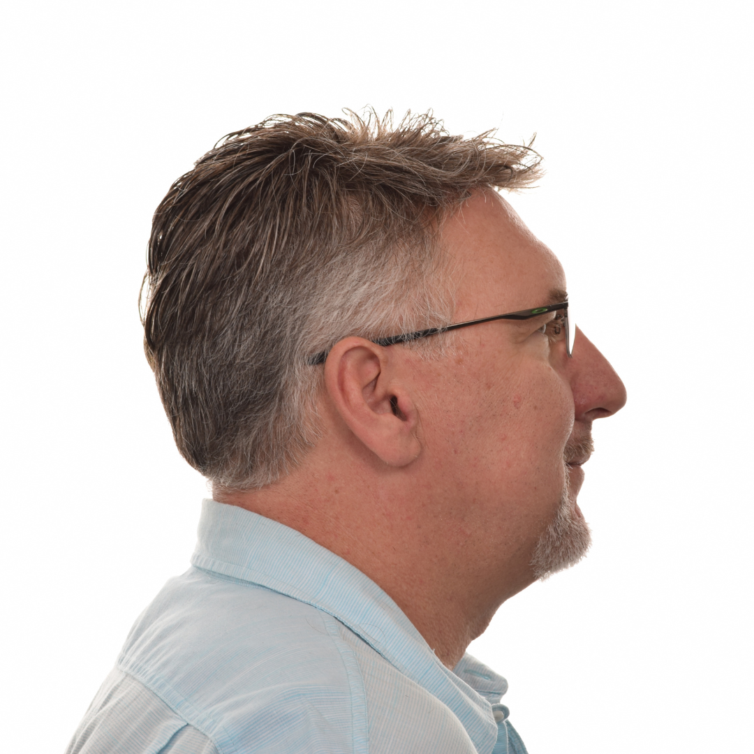 Jason-Shawver-Non-Surg-After-Right-Side