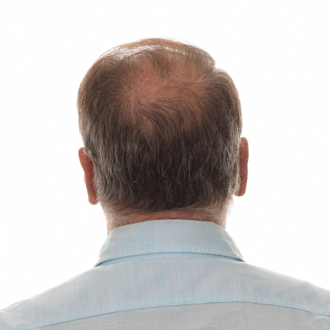 Jason-Shawver-Non-Surg-Before-Back