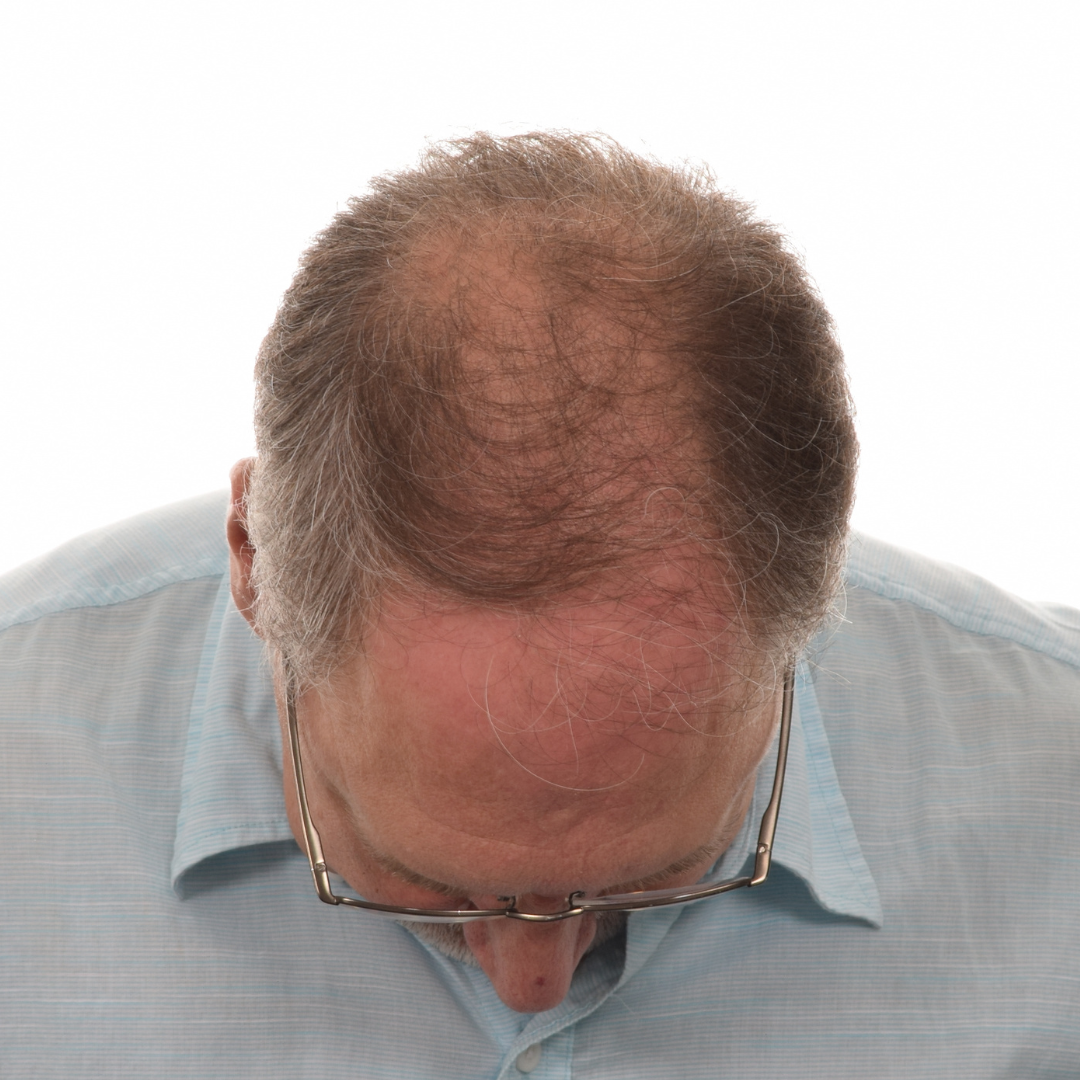 Jason-Shawver-Non-Surg-Before-Front-Tilt