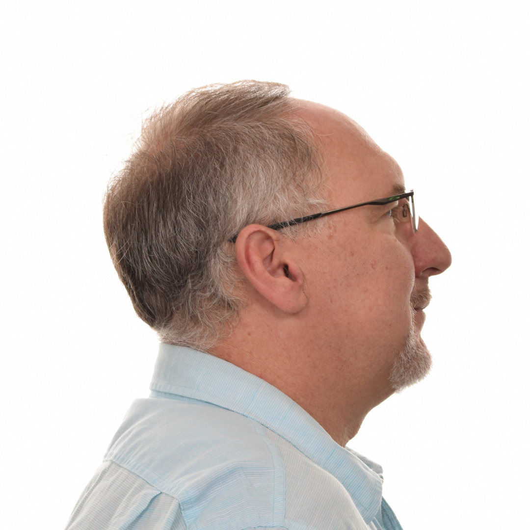 Jason-Shawver-Non-Surg-Before-Right-Side