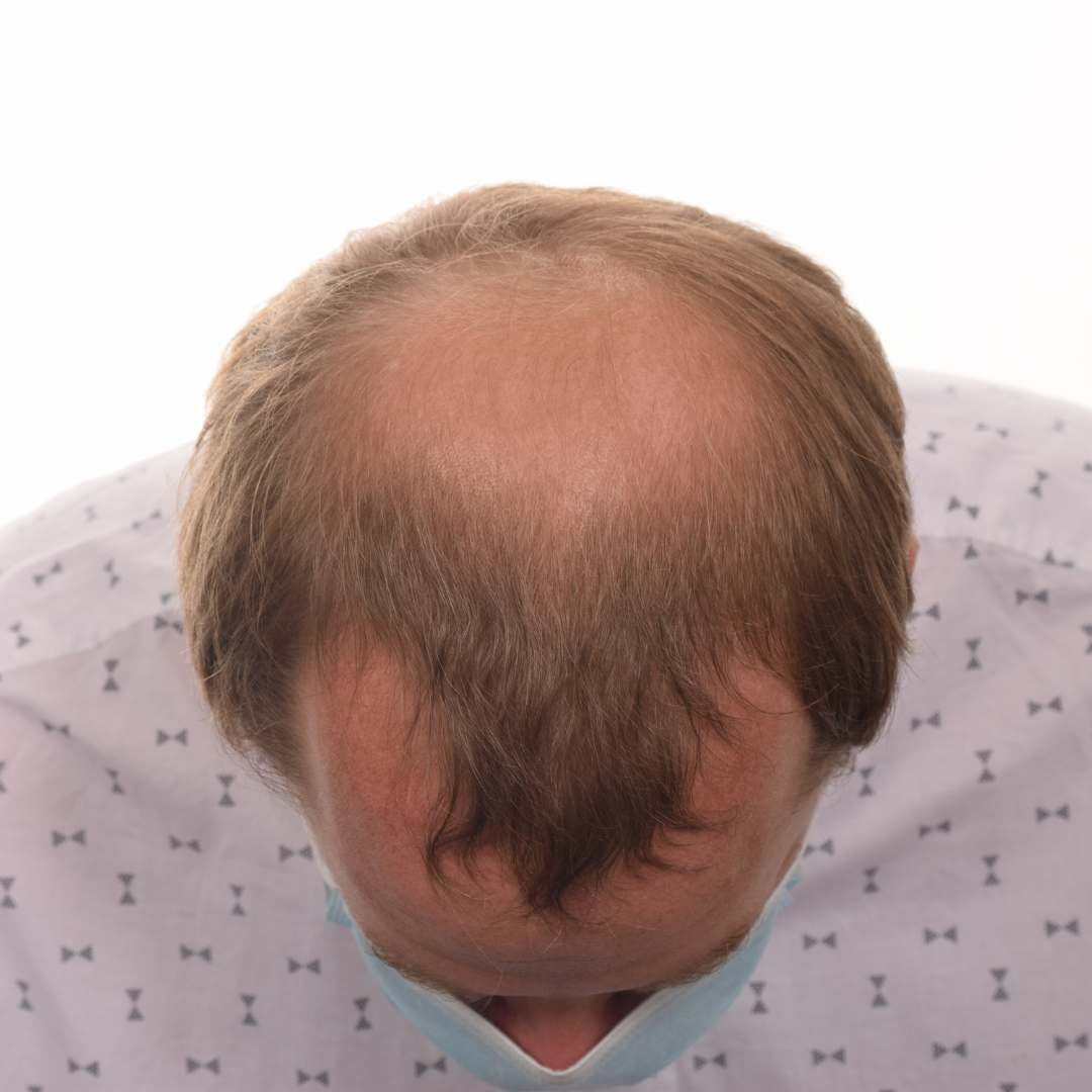 Thomas-Wagers-Front-Tilt-After