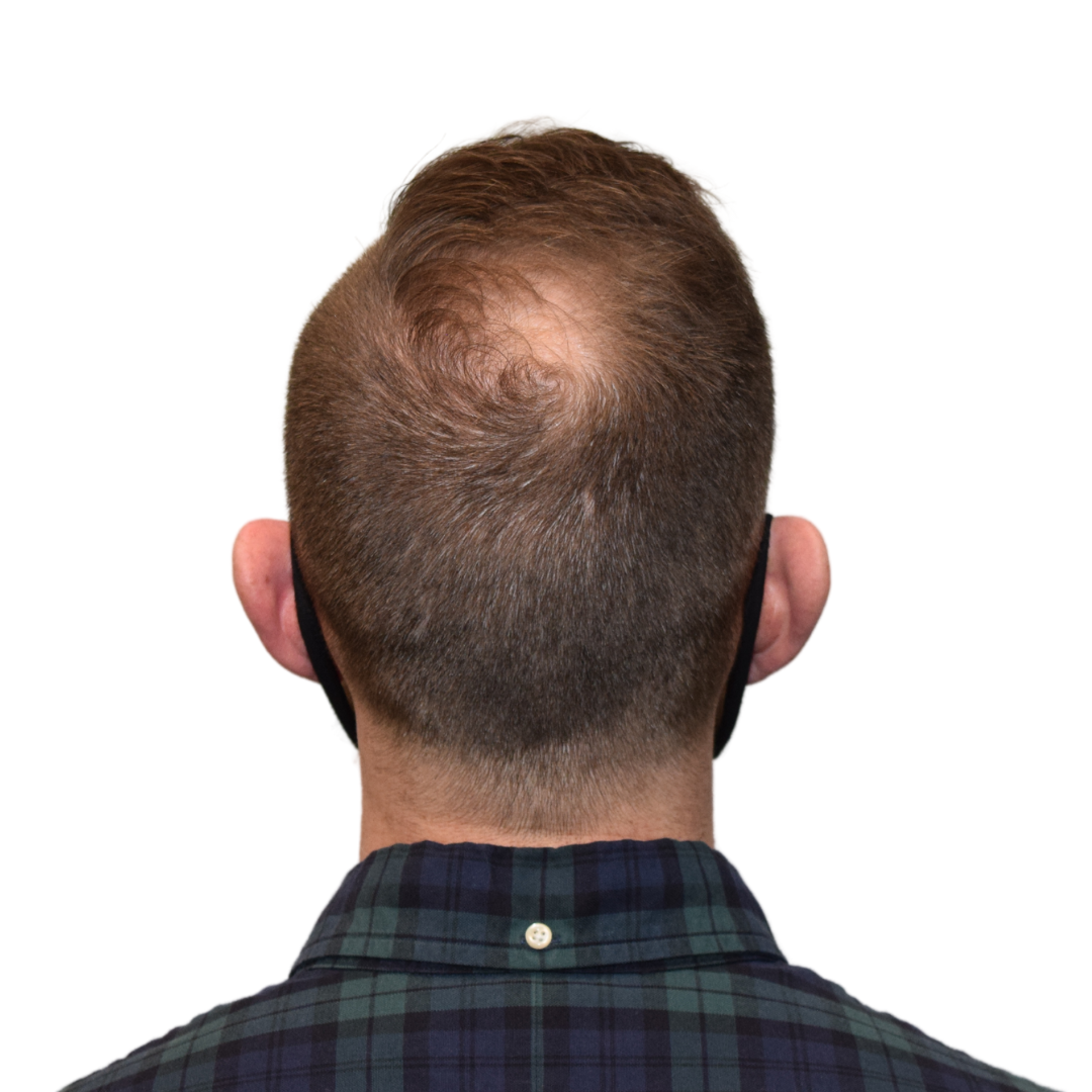 Mark-Clarke-Back-Tilt-Before