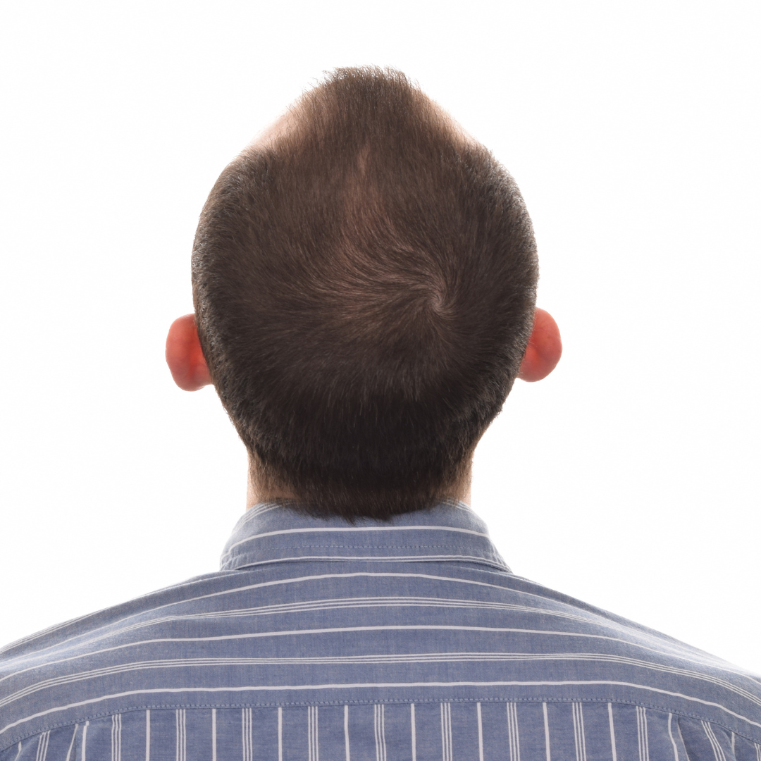 Stuart-Rhonemus-Back-Tilt-Before