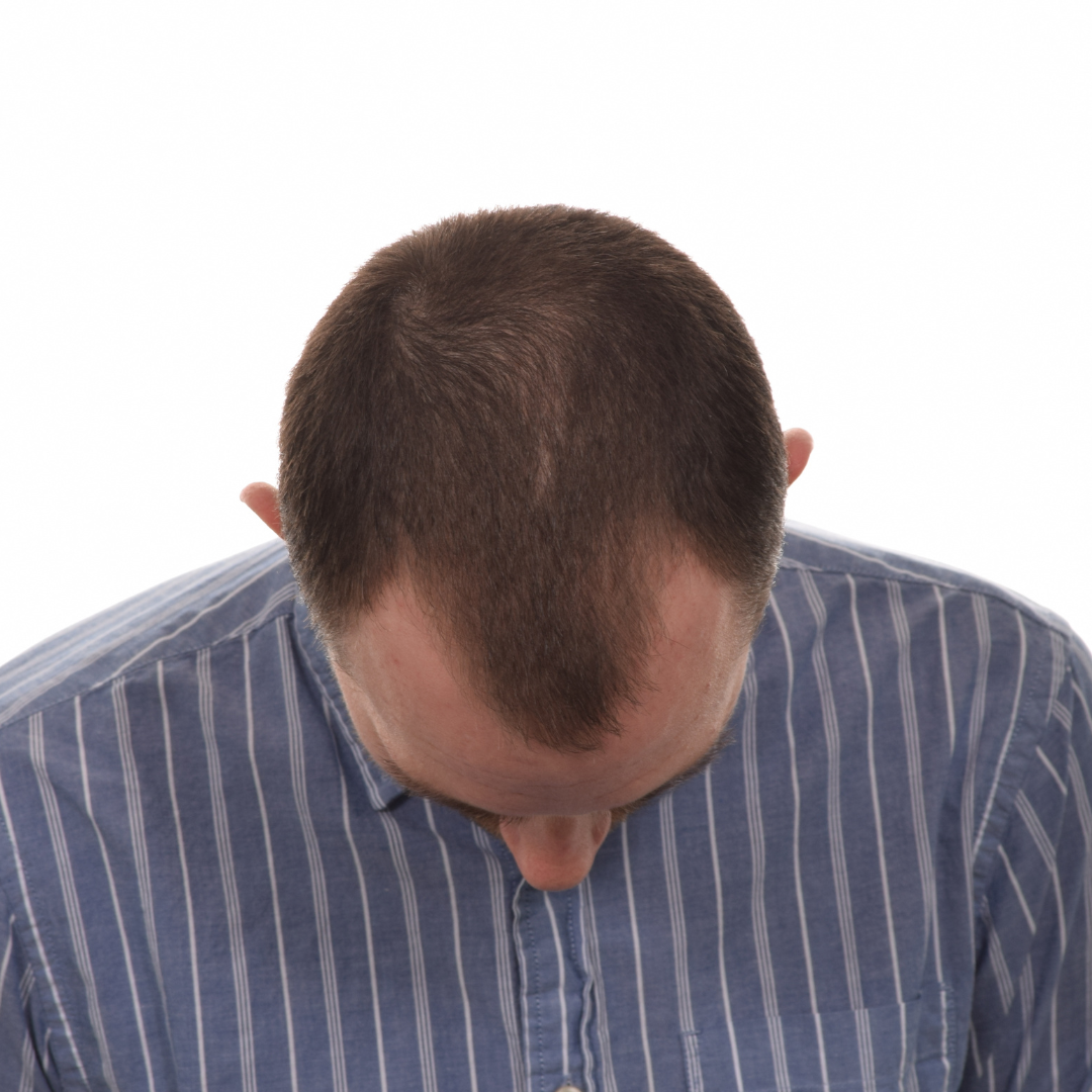 Stuart-Rhonemus-Front-Tilt-Before