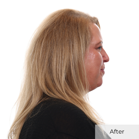 taylor j after right