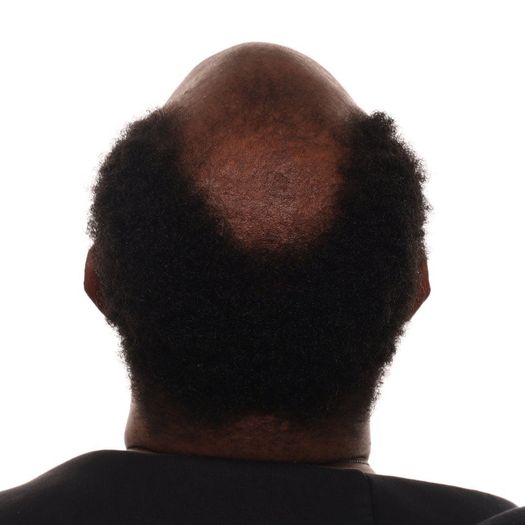 Daniel-Cole-back-tilt-before