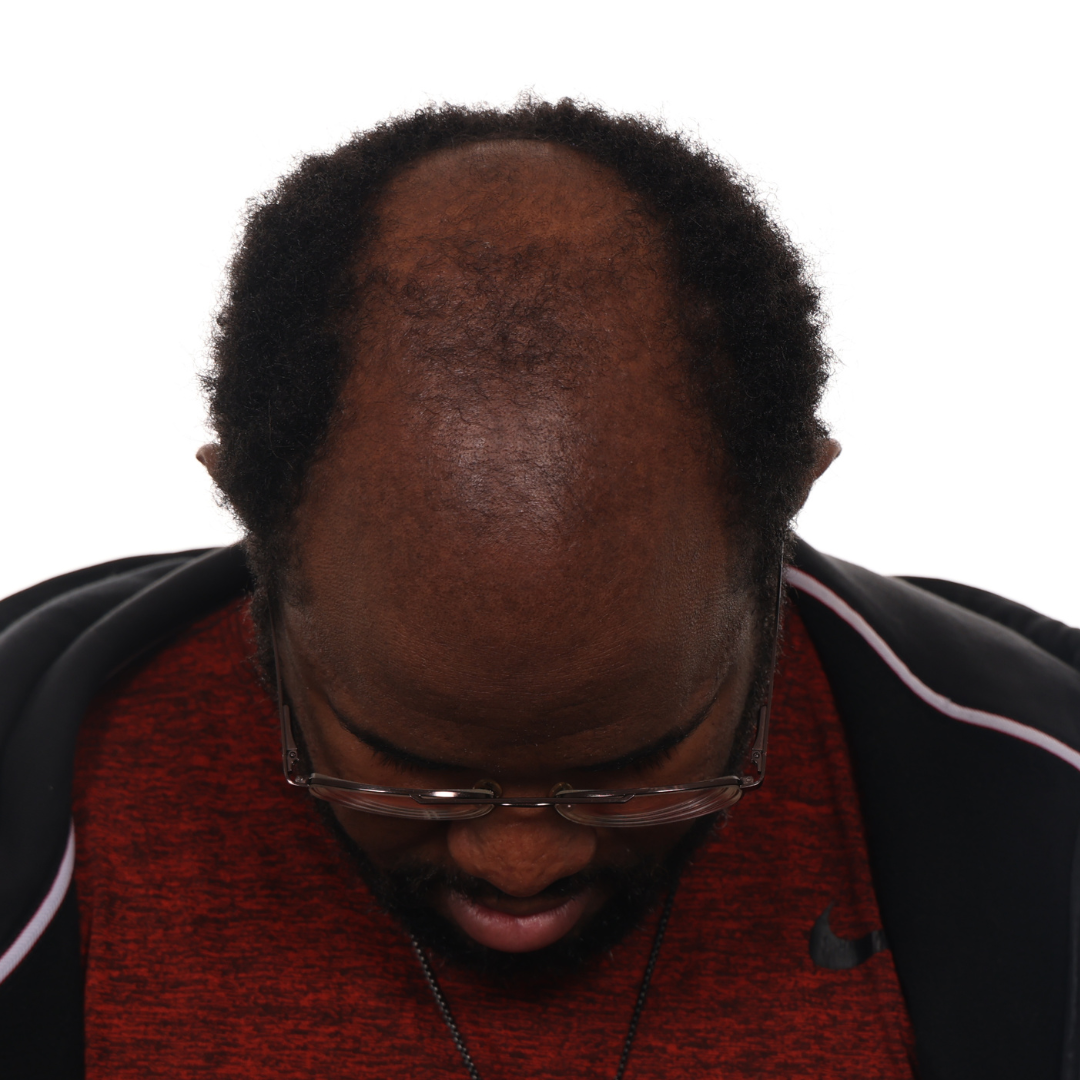 Daniel-Cole-front-tilt-before