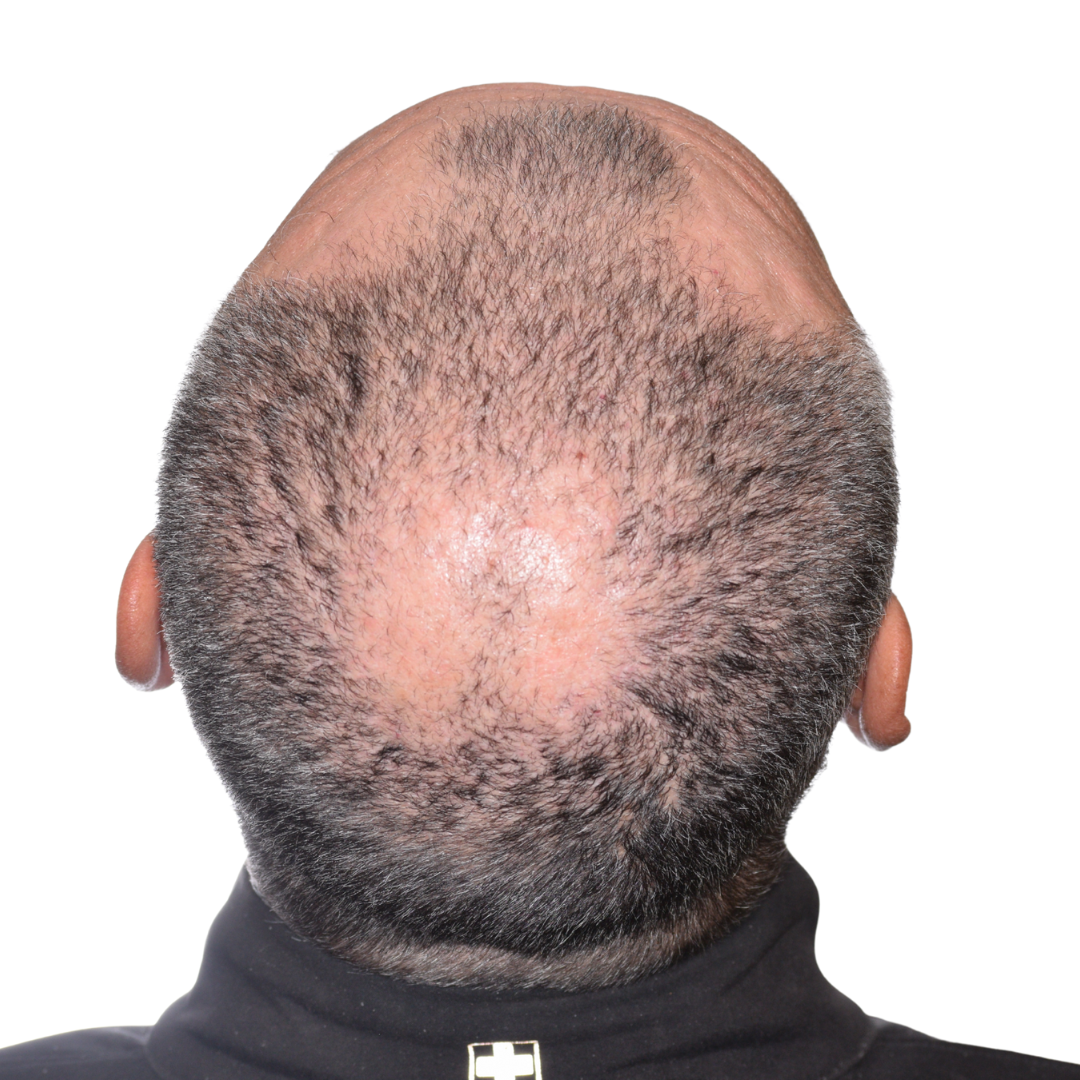 brian-taylor-back-tilt-after