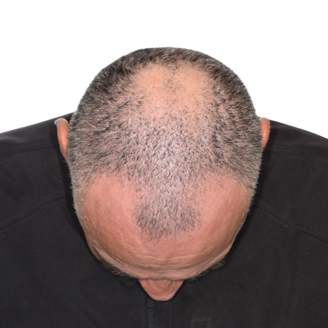 brian-taylor-front-tilt-before