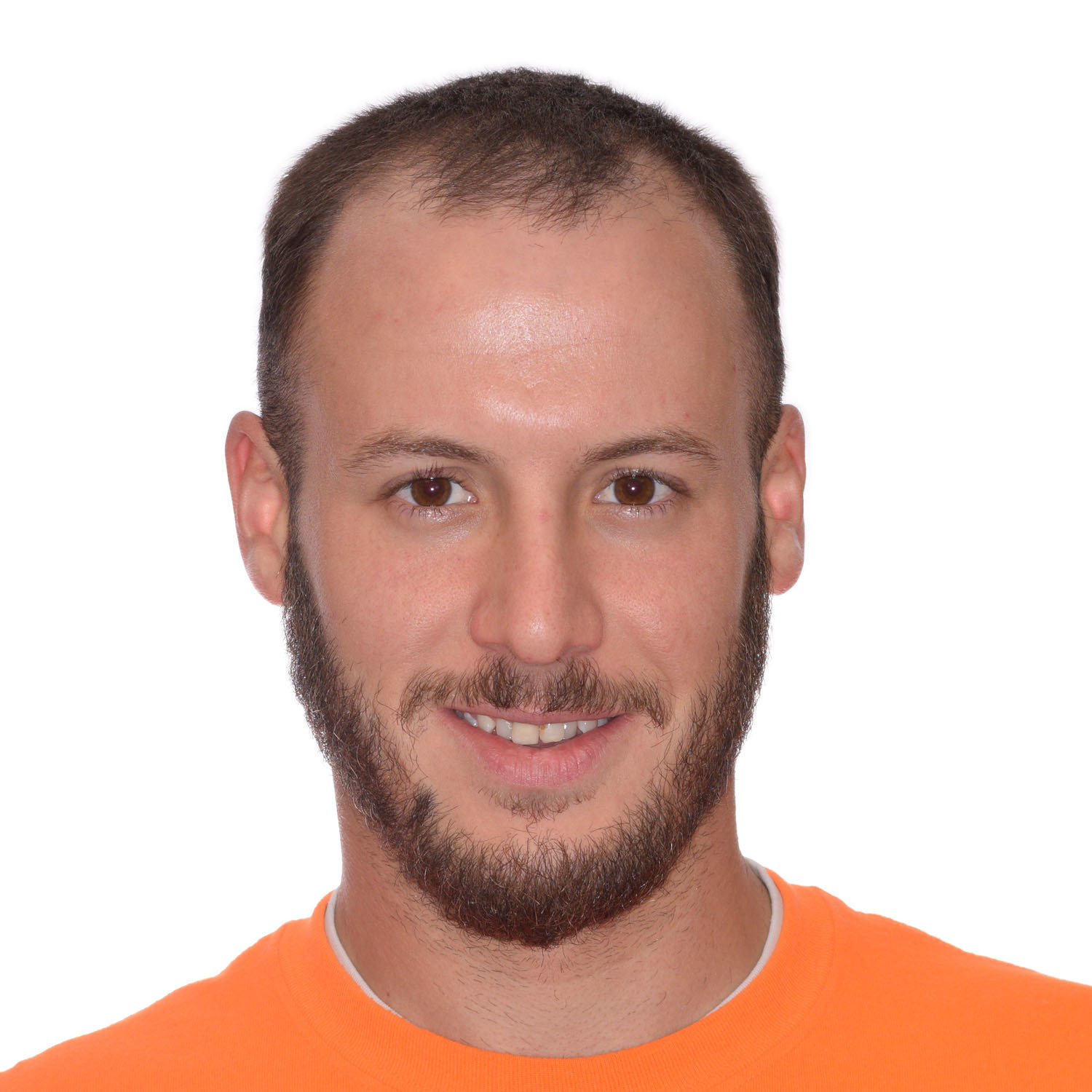 Nick Before FUE Hair Transplant