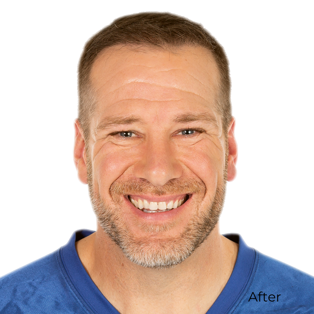 rick demulling after hair transplant