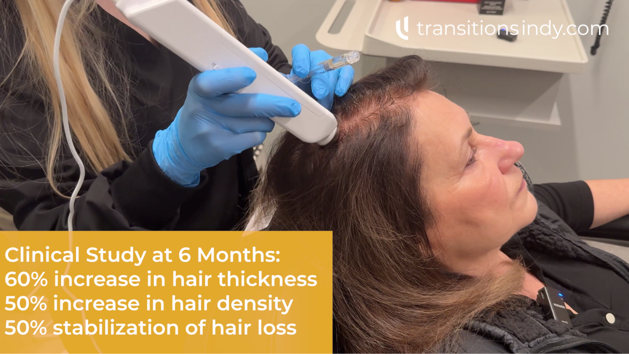 Ann Richards DE|RIVE Treatment at Transitions of Indiana