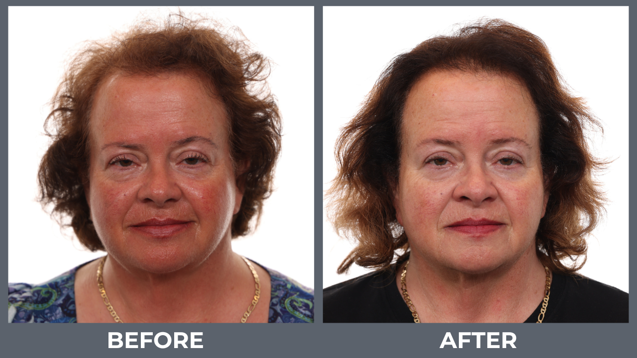 evt before and after