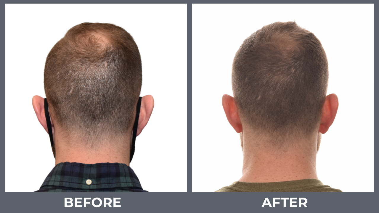 evt before and after