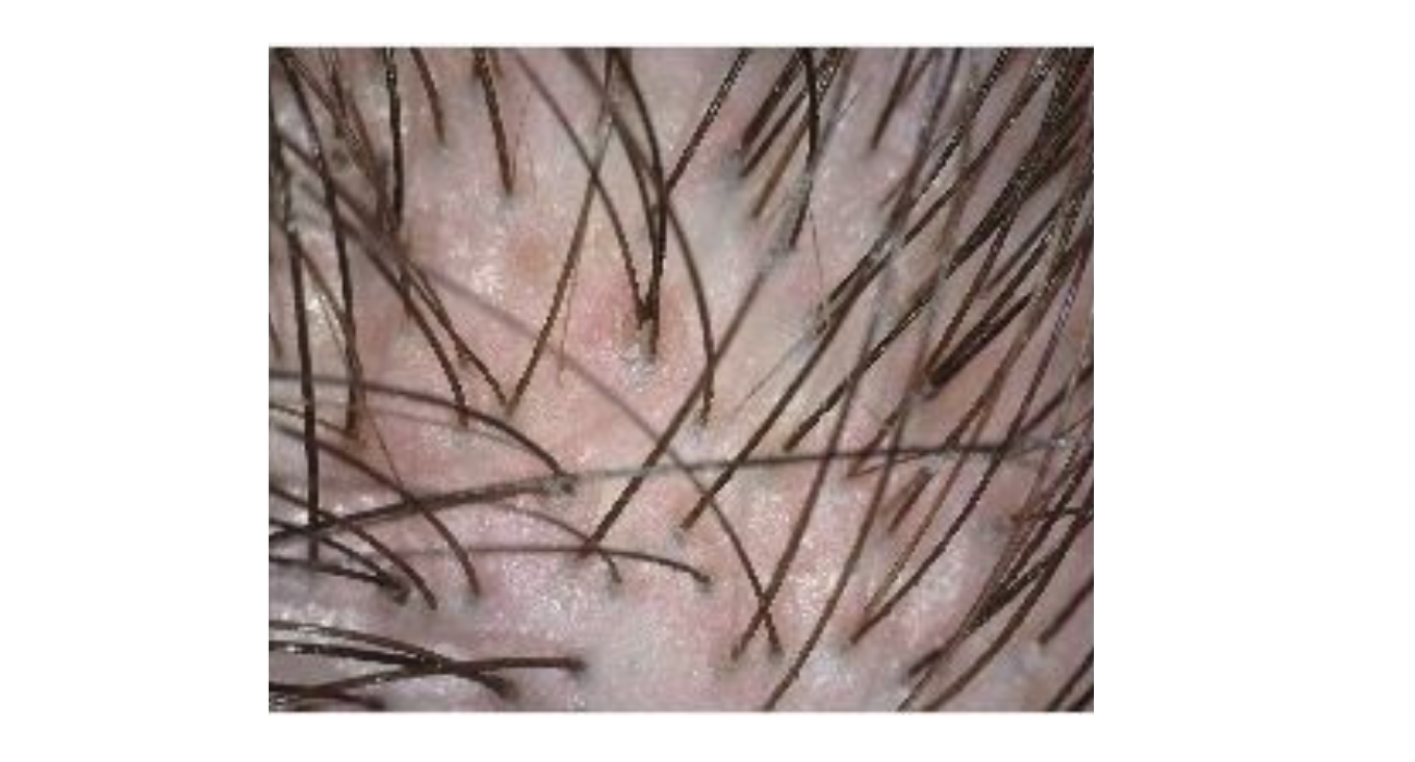 Microscopic scalp analysis close-up showing hair follicles