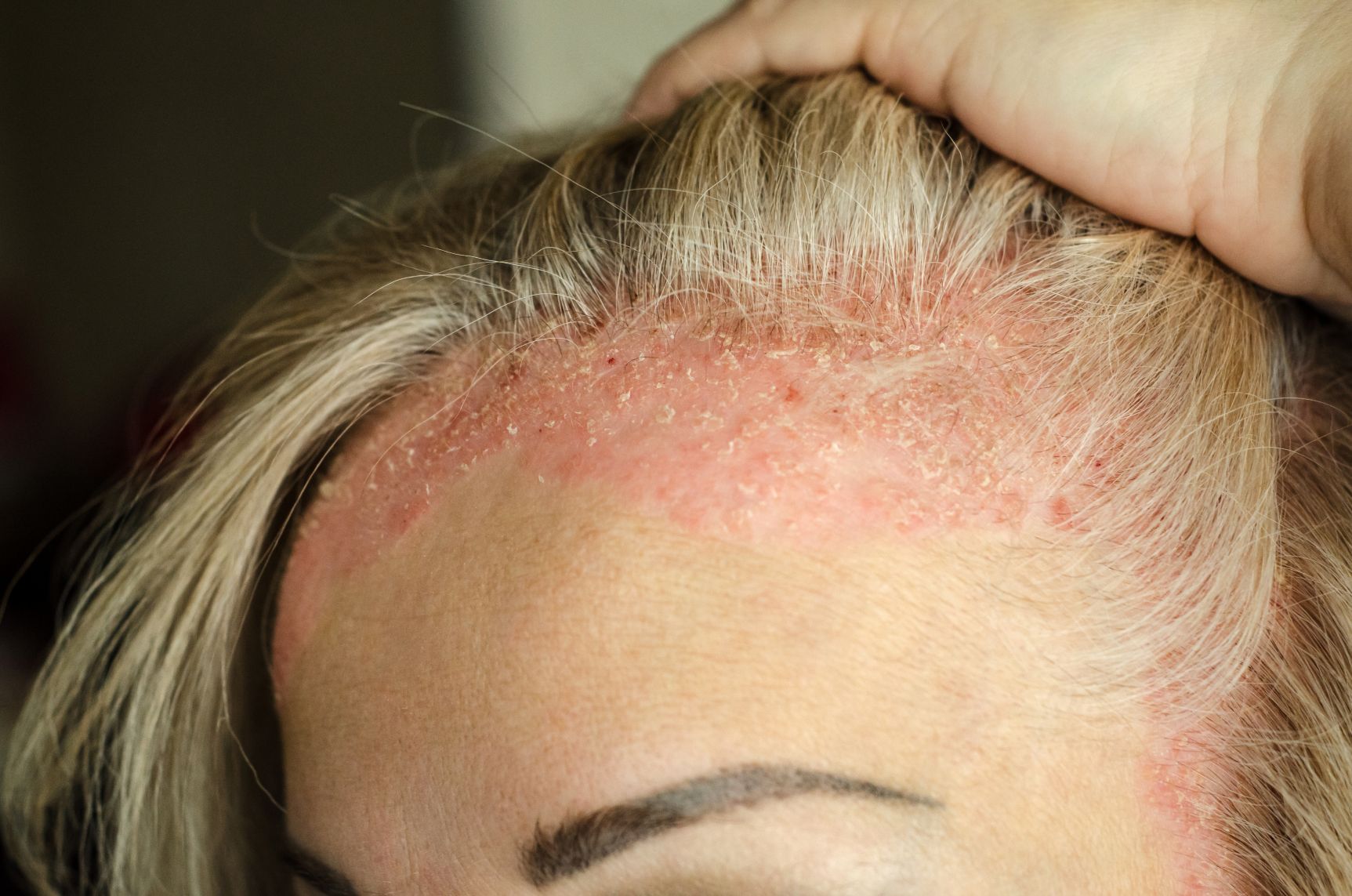 Scalp condition at the hairline
