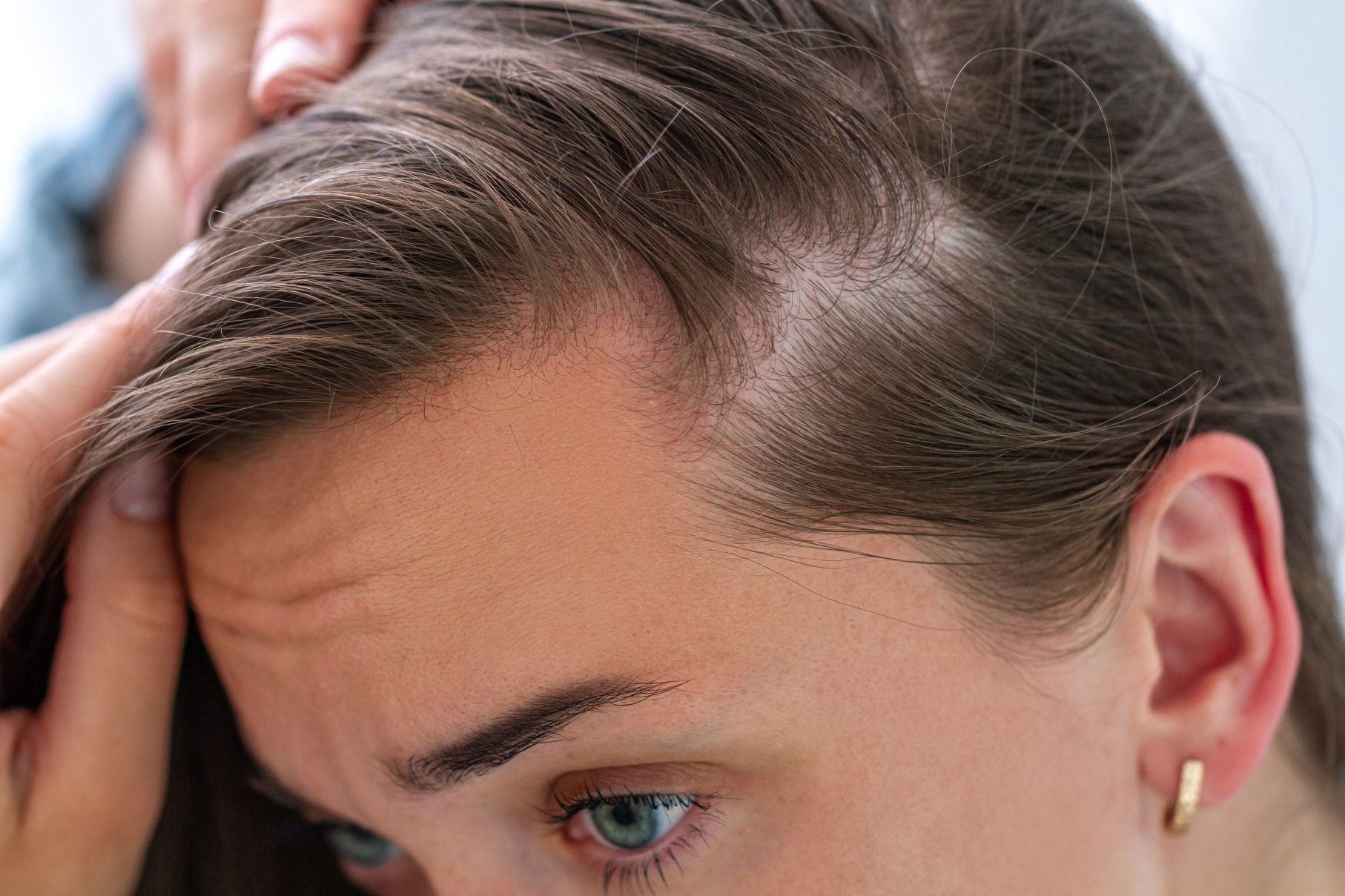 Hormonal hair loss at the temple