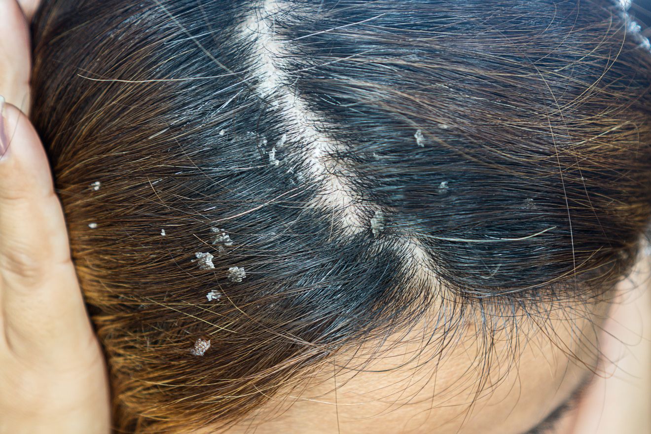 Flaking at the scalp part